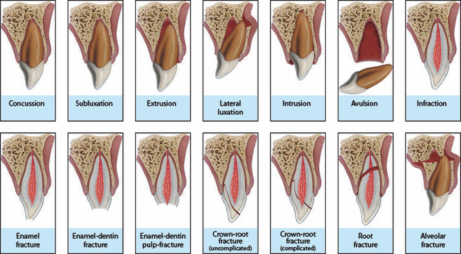 Traumatic Tooth injuries
