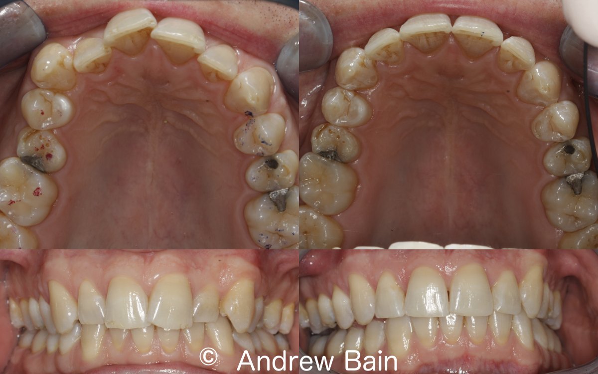 Before and after invisalign for crowding