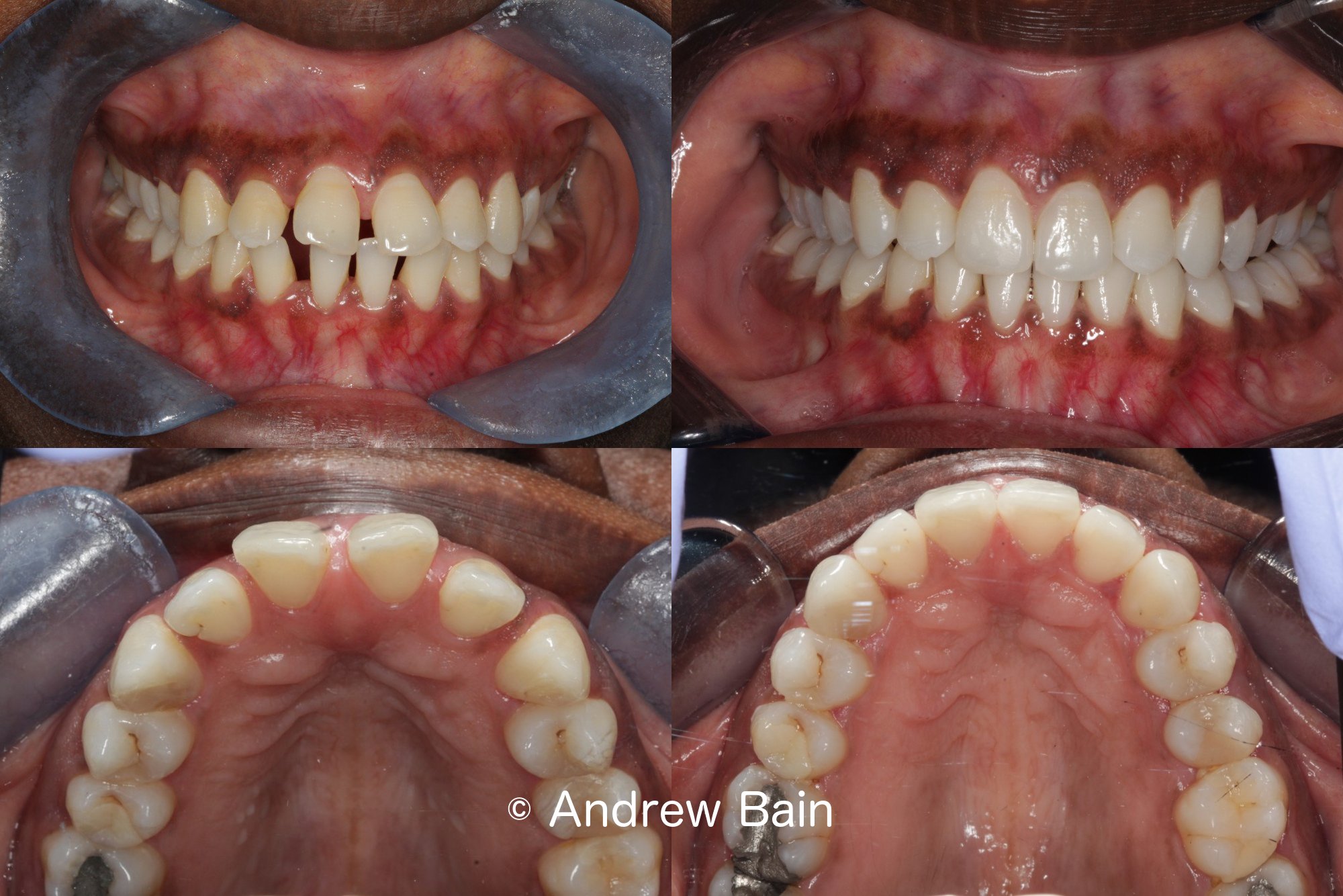Invisalign® used to close spaces